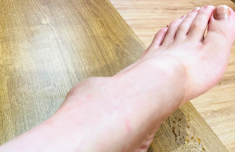 くるぶしの近くが腫れぷよぷよした痛くないコブって何?体験記 | Lifestyle