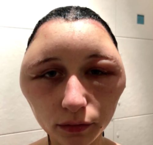 ダイヤ形に腫れた顔の原因はヘアカラー フランス人女性エステルさんアレルギー反応で恐怖体験 人体のナゾ